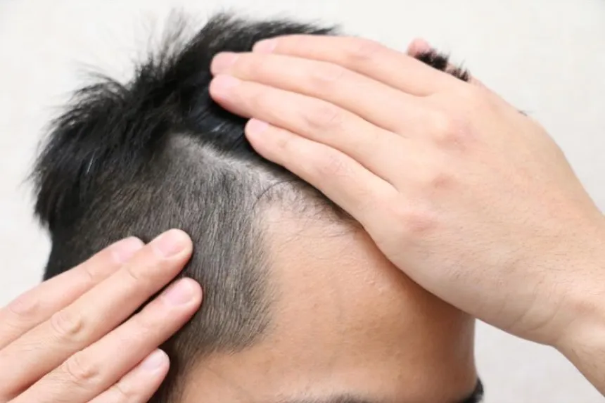 富士額とM字型の薄毛(ハゲ)には【違い】がある 2つの見分け方とは