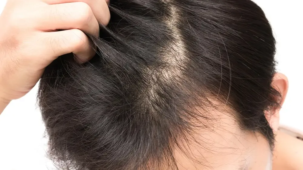 毛根から血が出る理由 髪を抜くと薄毛(ハゲ)に影響するのか?